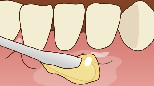 中原区・平間駅の親知らずの抜歯・親知らずの治療
