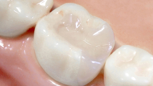 中原区・平間駅のなるべく歯を削らない治療