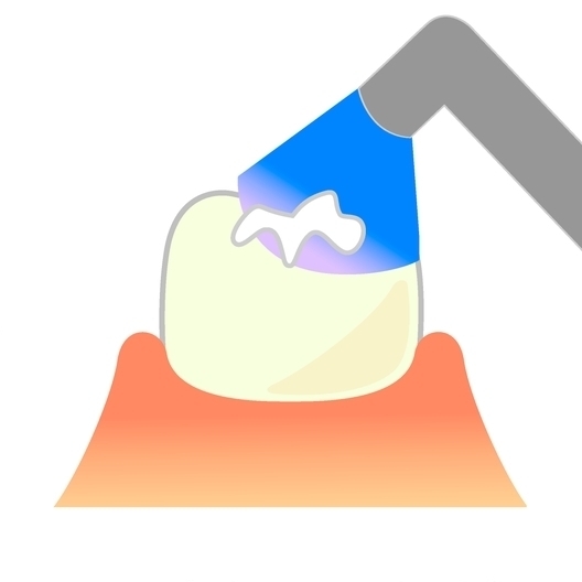 中原区・平間駅のなるべく歯を削らない治療