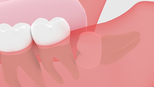 中原区・平間駅の親知らずの抜歯・親知らずの治療