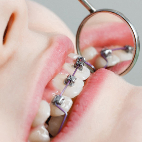 中原区・平間駅の小児矯正